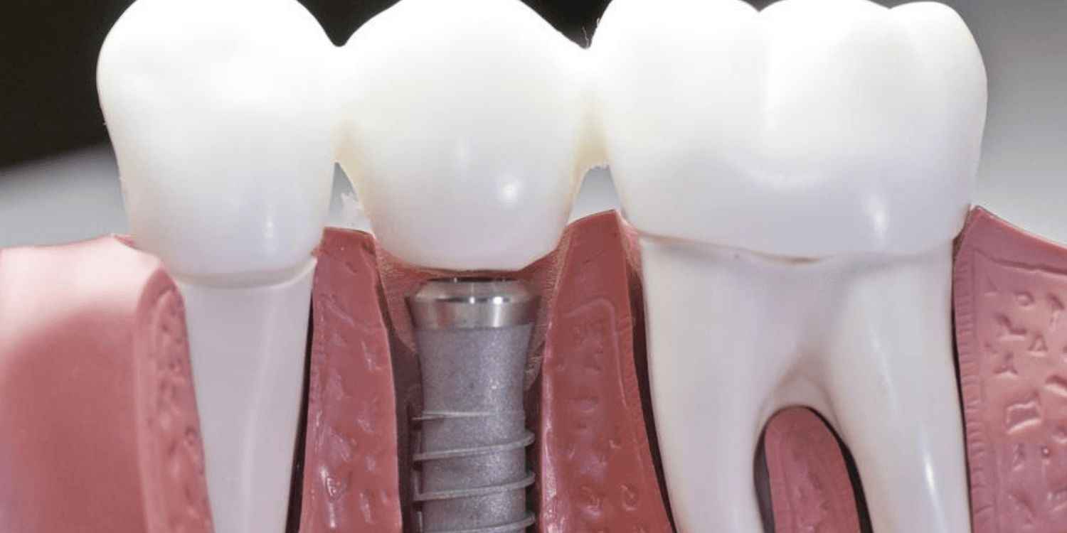 The Evolution and Importance of Dental Implants in Modern Dentistry